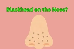 What is Blackhead on Nose? | Causes, Remedies & Prevention in Detail